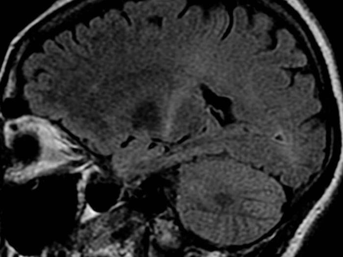An MRI (parasagittal FLAIR) demonstrates increased T2 signal within the posterior part of the internal capsule and can be tracked to the subcortical white matter of the motor cortex, outlining the corticospinal tract), consistent with the clinical diagnosis of ALS